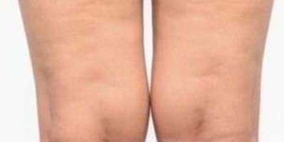 吸脂失敗修復術前