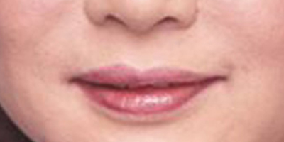 注射去口周紋術后