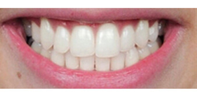 超聲波洗牙術后