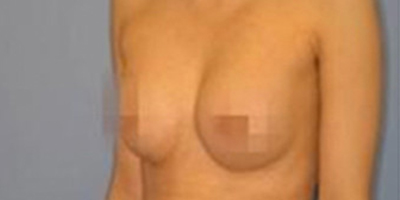 自體脂肪隆胸術后