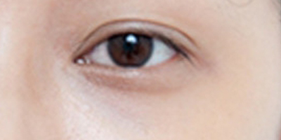 自體脂肪豐眼窩術(shù)后