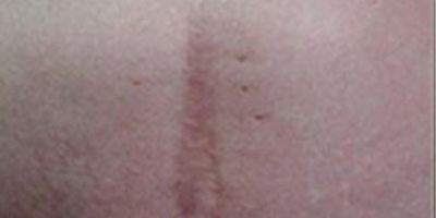 注射祛疤術(shù)前