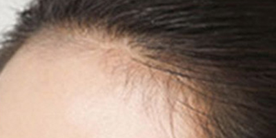 半永久發(fā)際線術(shù)后