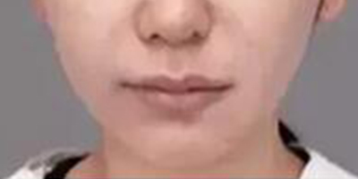 彩光嫩膚術(shù)前