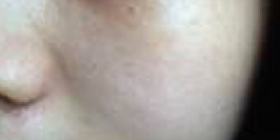 玻尿酸導(dǎo)入術(shù)前