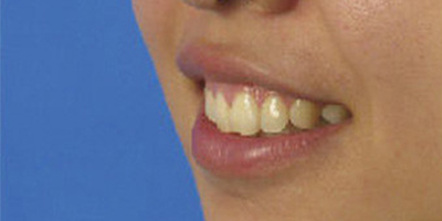 手術(shù)去露齦笑術(shù)前