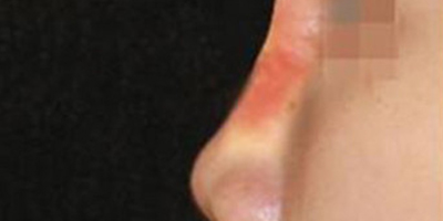 注射物取出術(shù)前