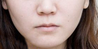 嘴角上揚術術前