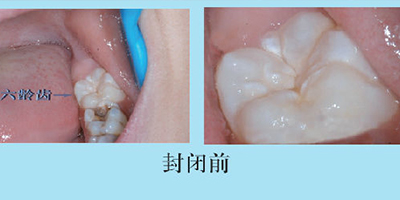 兒童口腔預(yù)防窩溝封閉術(shù)前