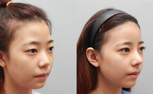 耳軟骨隆鼻的優(yōu)缺點是什么？肋軟骨隆鼻和耳軟骨隆鼻有什么區(qū)別？