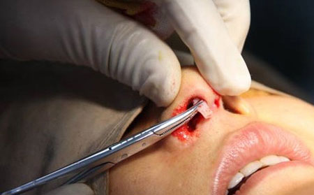 鼻子假體取出需要多少錢？取出后鼻子會恢復(fù)原來樣子嗎？