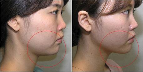 雙下巴吸脂多長(zhǎng)時(shí)間恢復(fù)？雙下巴吸脂術(shù)能保持多久？