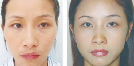 假體填充豐太陽穴怎么做？假體豐太陽穴的方法有哪些？