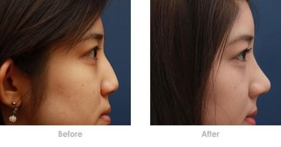 隆鼻假體取出后鼻子會不會變形？隆鼻假體取出后能不能恢復(fù)原樣？