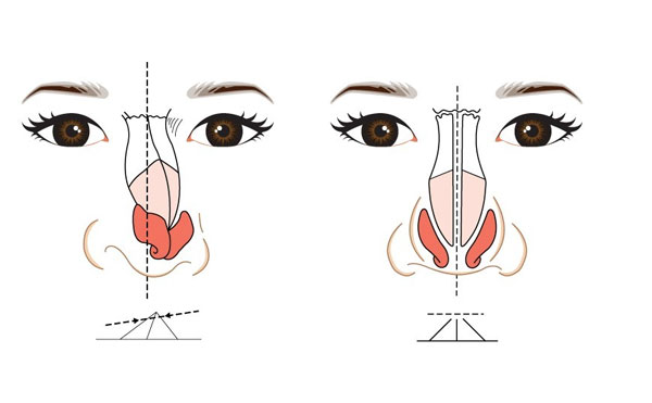 歪鼻矯正術的風險大嗎?鼻梁歪怎么矯正歪鼻的矯正及補救方法?