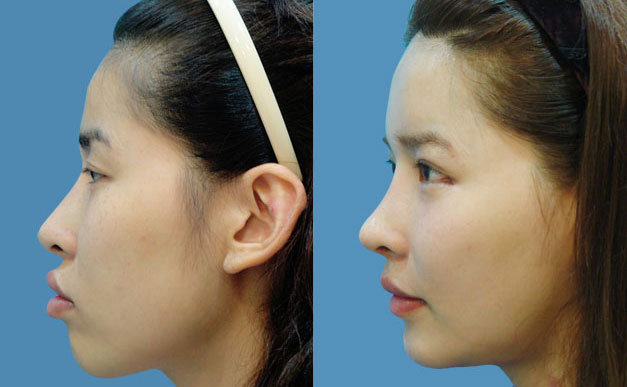 上下顎矯正術(shù)是什么手術(shù)啊？下頜角骨骼大用什么方法去除？