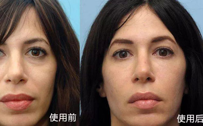 法令紋去除手術(shù)效果好嗎？法令紋怎么消除?最好的方法是什么？