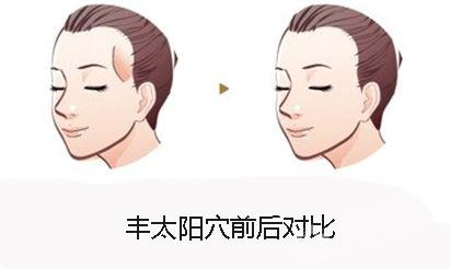 什么是自體脂肪豐太陽穴？用自體脂肪豐太陽穴的效果能維持多久？