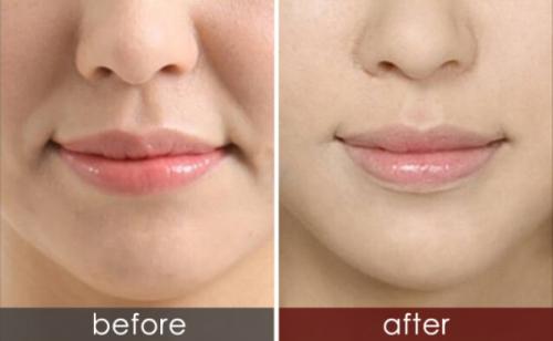 玻尿酸祛除法令紋的優(yōu)勢？玻尿酸和肉毒素祛法令紋，哪一種效果好？