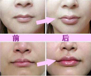 玻尿酸豐唇珠效果怎么樣？玻尿酸豐唇珠多少錢？