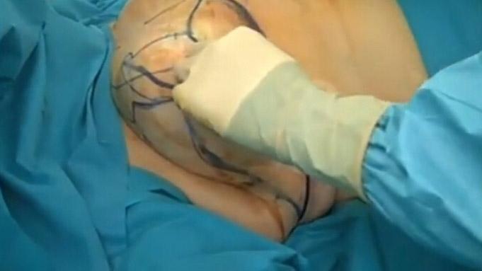 乳房縮小手術(shù)要多少錢？乳房縮小術(shù)是大手術(shù)嗎？