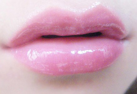 自體脂肪豐唇效果好嗎？自體脂肪豐唇大概多少錢(qián)？