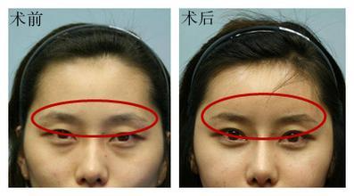 自體脂肪填充眉弓安全嗎？自體脂肪填充是永久的嗎？