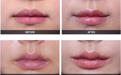 嘴角上揚(yáng)術(shù)有幾種方法？嘴角上揚(yáng)術(shù)疤痕恢復(fù)期？