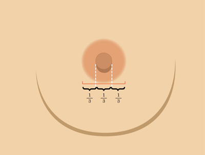 乳暈縮小如何矯正 乳暈縮小術(shù)的注意事項有哪些？