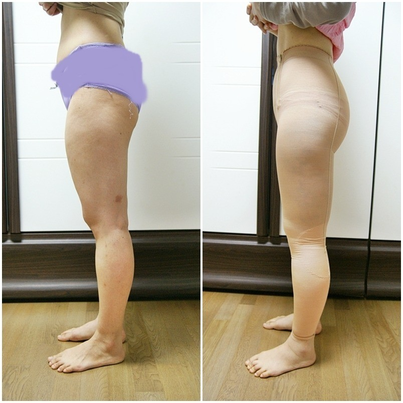 吸脂瘦大腿腫脹期是多久？大腿吸脂有什么后遺癥嗎？