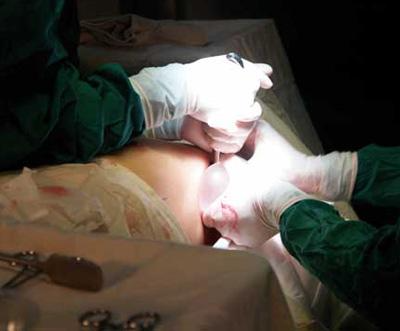 胸部假體取出多久可以重新做 ？胸部假體取出注意事項(xiàng)？