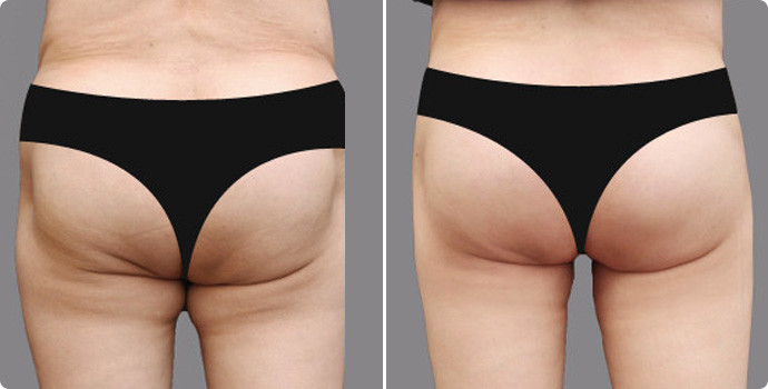 吸脂瘦臀部?jī)r(jià)格多少？吸脂瘦臀術(shù)后如何護(hù)理？
