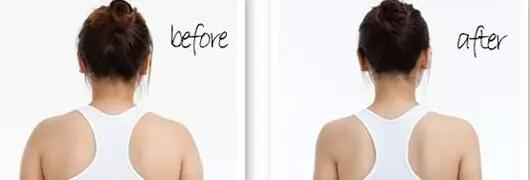 后背抽脂那些人可以做？吸脂瘦肩膀多少錢？