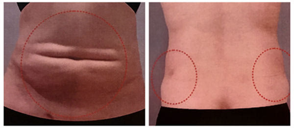 吸脂失敗了多久可以修復？吸脂失敗修復怎么解決？