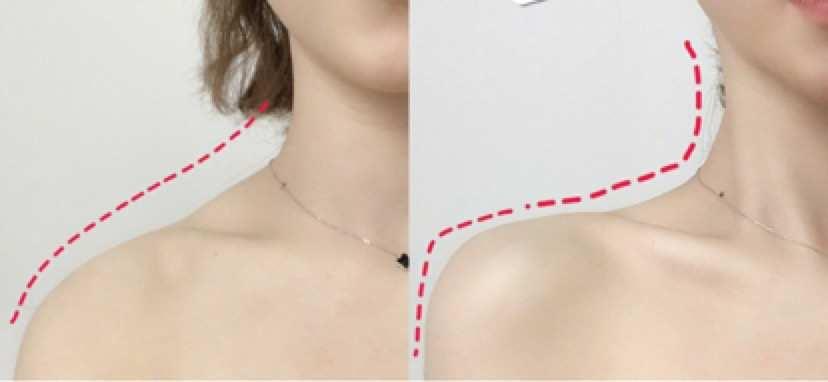 隔空溶脂瘦肩部注意事項(xiàng) 隔空溶脂瘦肩部如何術(shù)后護(hù)理