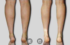 隔空溶脂瘦小腿后如何術(shù)后護理  隔空溶脂瘦小腿多少錢
