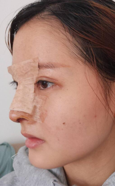 上海藝星醫(yī)療美容醫(yī)院做隆鼻手術后的第三天情況