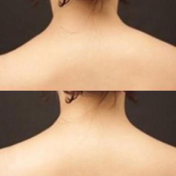 隔空溶脂瘦肩部注意事項(xiàng) 隔空溶脂瘦肩部如何術(shù)后護(hù)理