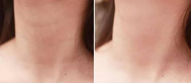 嗨體去頸紋幾天有效果 嗨體去頸紋如何延長維持時(shí)間