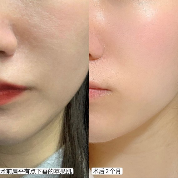 少女針是什么？少女針和玻尿酸填充哪個好？