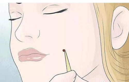 激光點痣要多久才會恢復(fù)？激光點痣多少錢？