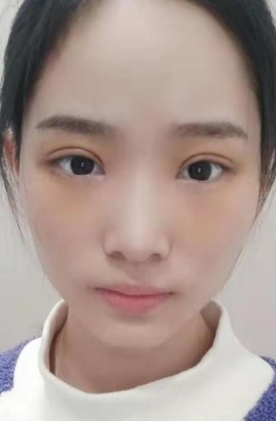 長沙星雅醫(yī)療美容醫(yī)院萬友望雙眼皮案例效果分享