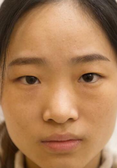 長沙星雅醫(yī)療美容醫(yī)院做雙眼皮手術(shù)前 長沙星雅醫(yī)療美容醫(yī)院做雙眼皮手術(shù)前