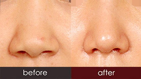 成都菲爾整形做鼻翼縮小術(shù)怎么樣？鼻翼縮小術(shù)安全嗎？