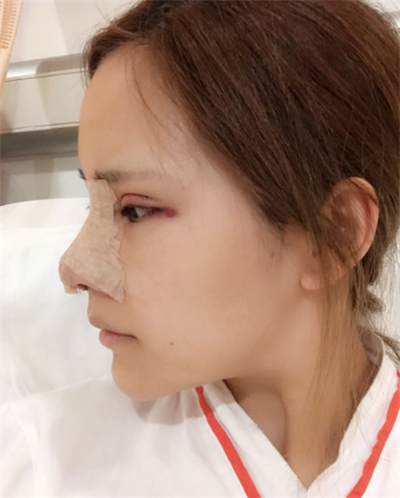 深圳弘美醫(yī)療美容門診部做眼綜合手術(shù)后 深圳弘美醫(yī)療美容門診部做眼綜合手術(shù)后