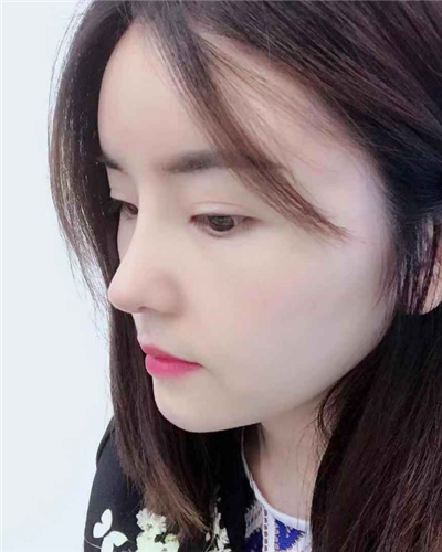 煙臺(tái)壹美整形美容醫(yī)院做隆鼻手術(shù)后整個(gè)鼻子的情形 煙臺(tái)壹美整形美容醫(yī)院做隆鼻手術(shù)后整個(gè)鼻子的情形