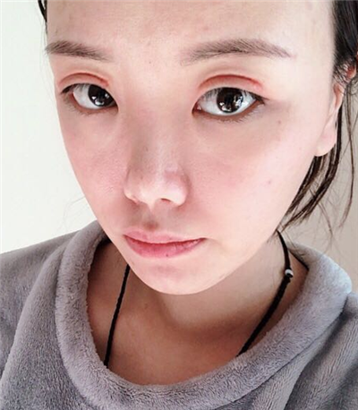 珠海韓妃醫(yī)療美容門診部做雙眼皮術(shù)后的最終情況 珠海韓妃醫(yī)療美容門診部做雙眼皮術(shù)后的最終情況