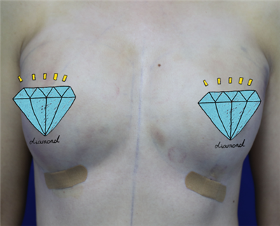 煙臺(tái)壹美整形美容醫(yī)院馬福順隆胸案例效果分享