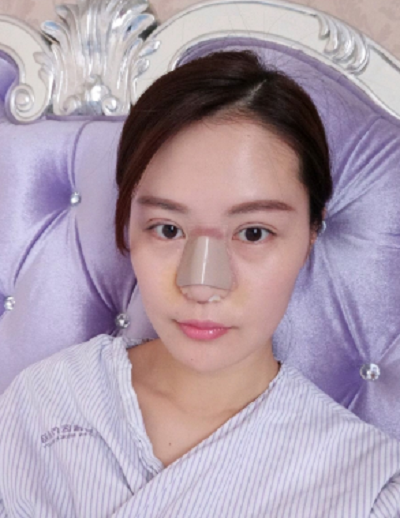 寧波尚美整形美容醫(yī)院齊強鼻綜合案例效果分享