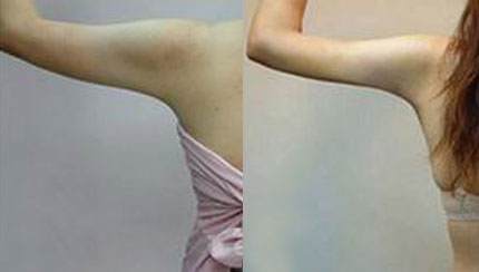  成都春語(yǔ)整形做手臂吸脂治術(shù)后效果好嗎？